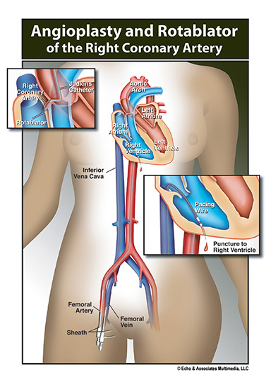 Right Coronary Artery